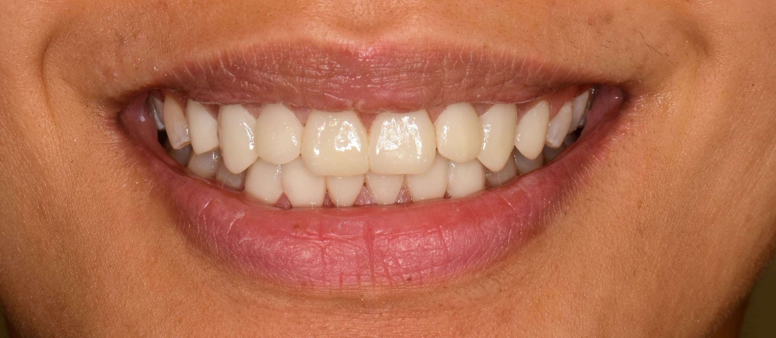 Next-day Veneers