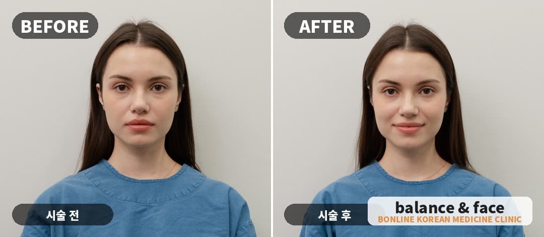 Facial asymmetry treatment (balance & face)