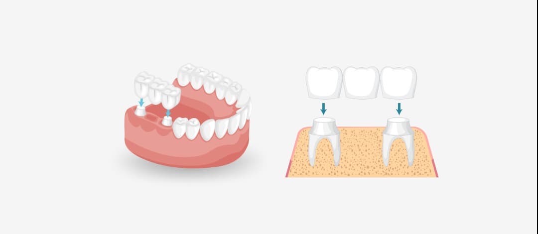 Dental implant customized solution