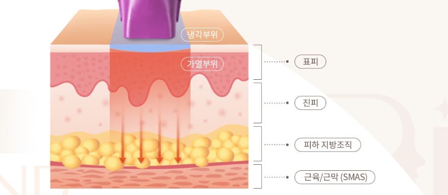 써마지 FLX