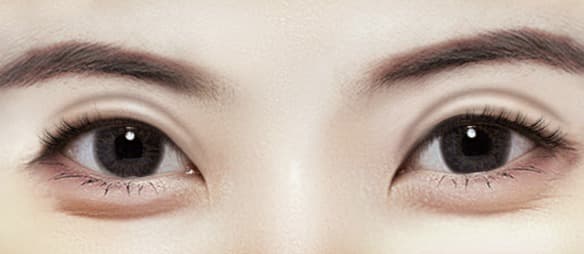 Lowering the eyelid crease (double-line revision + fat repositioning)
