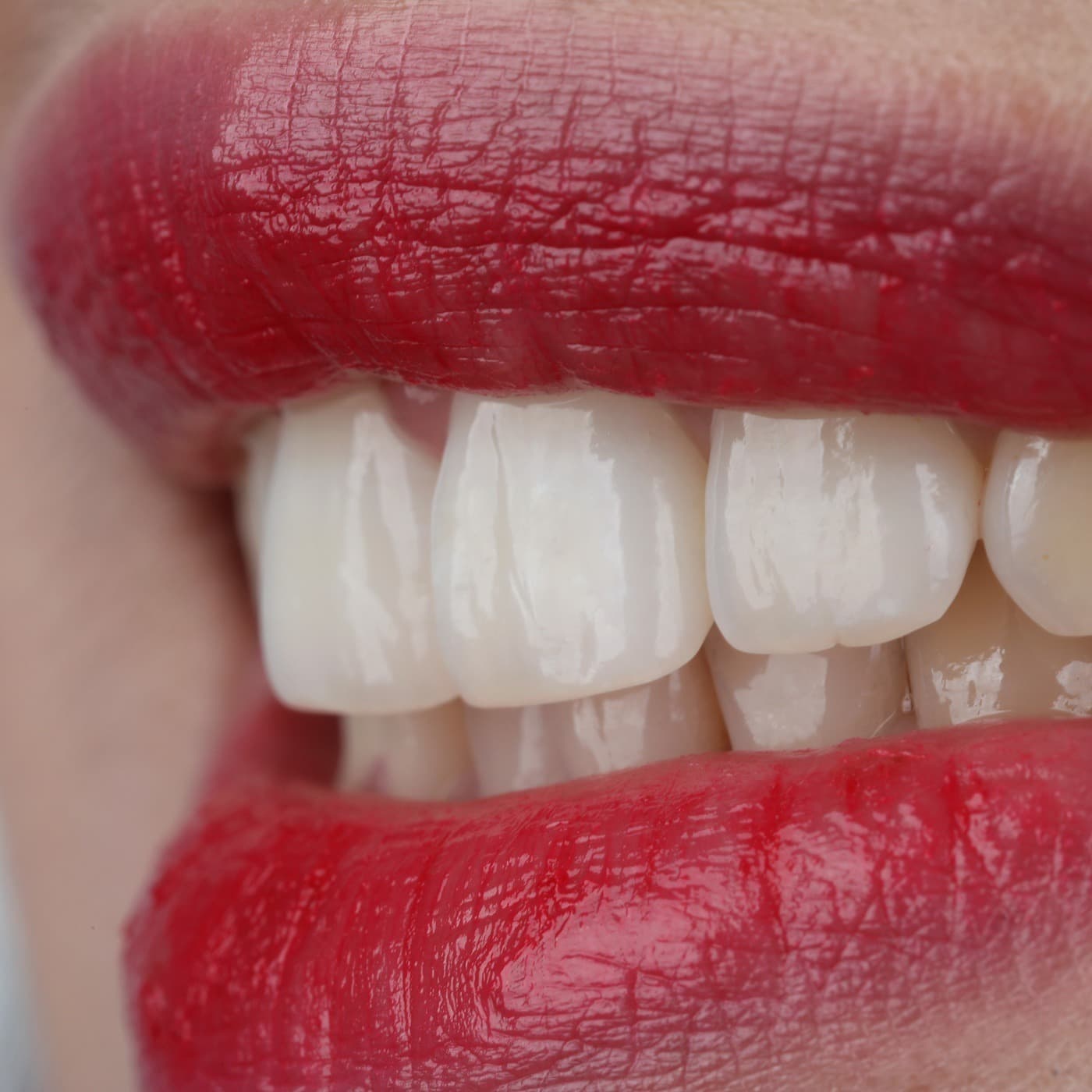 Professional teeth whitening