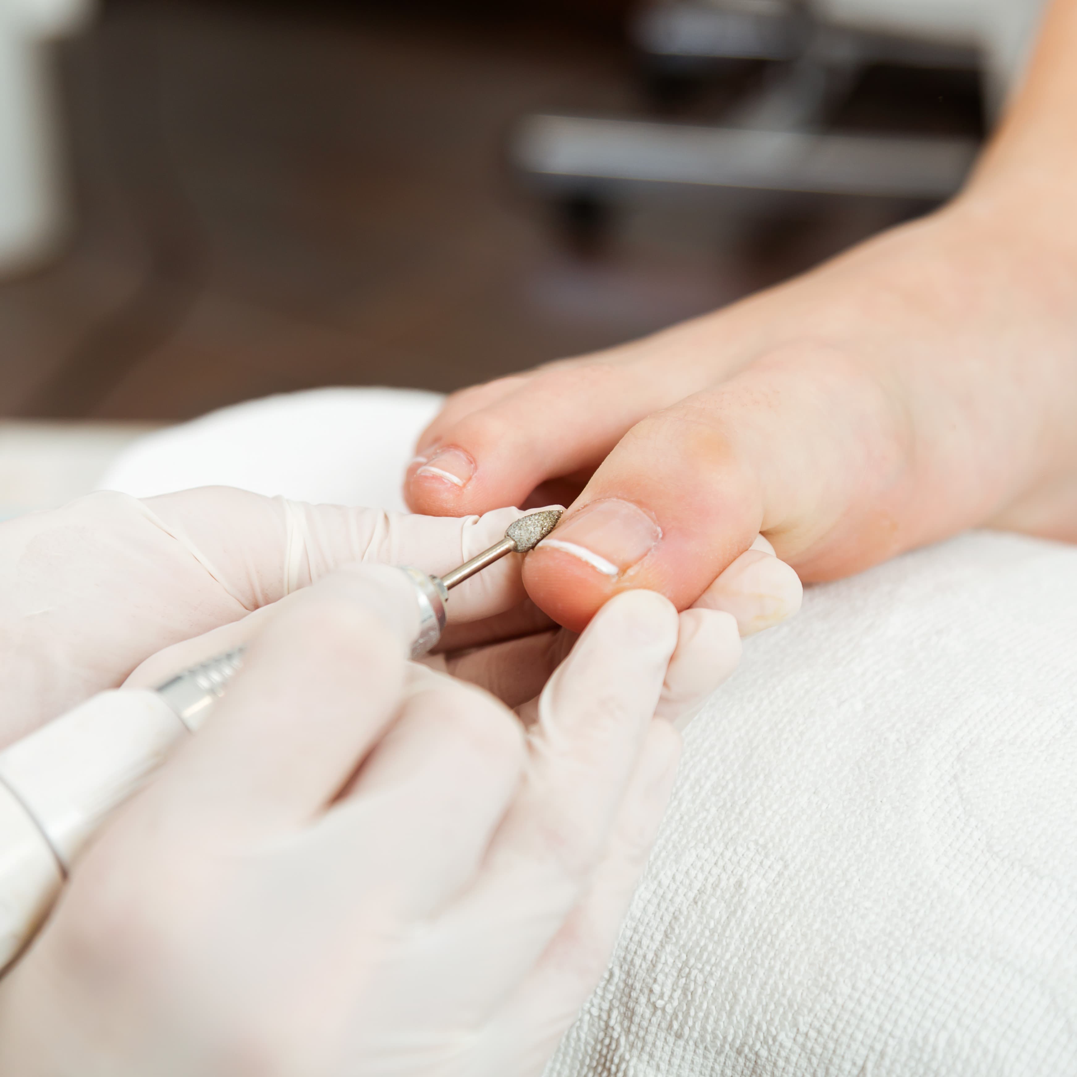 Treatment for INSS (Ingrowing Nail Sympathetic Syndrome)