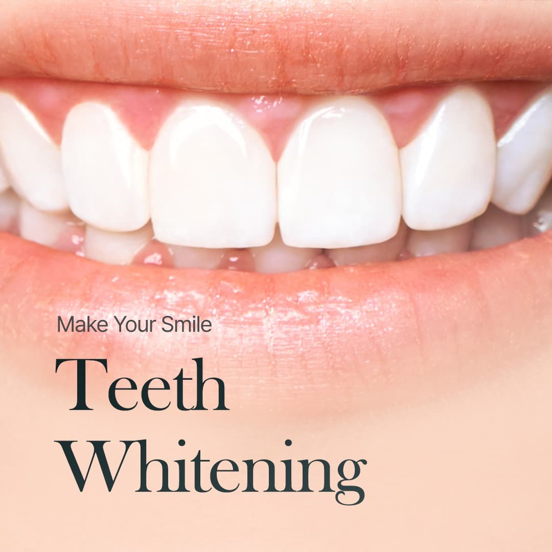 Professional teeth whitening in Gangnam