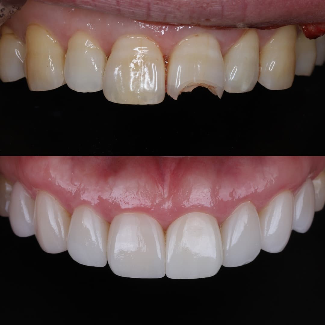 Laminate 5.0 (Microscope-assisted natural tooth preservation aesthetic Laminate)