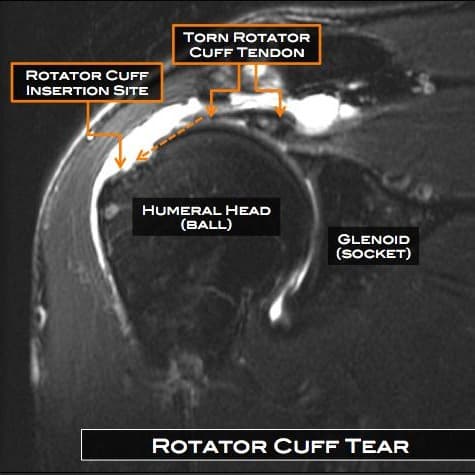 Rotator cuff tear
