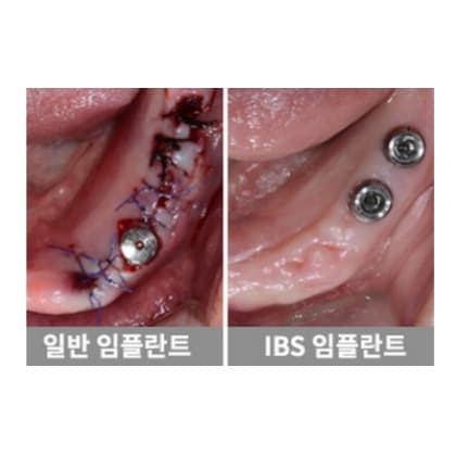 무절개, 최소절개 임플란트