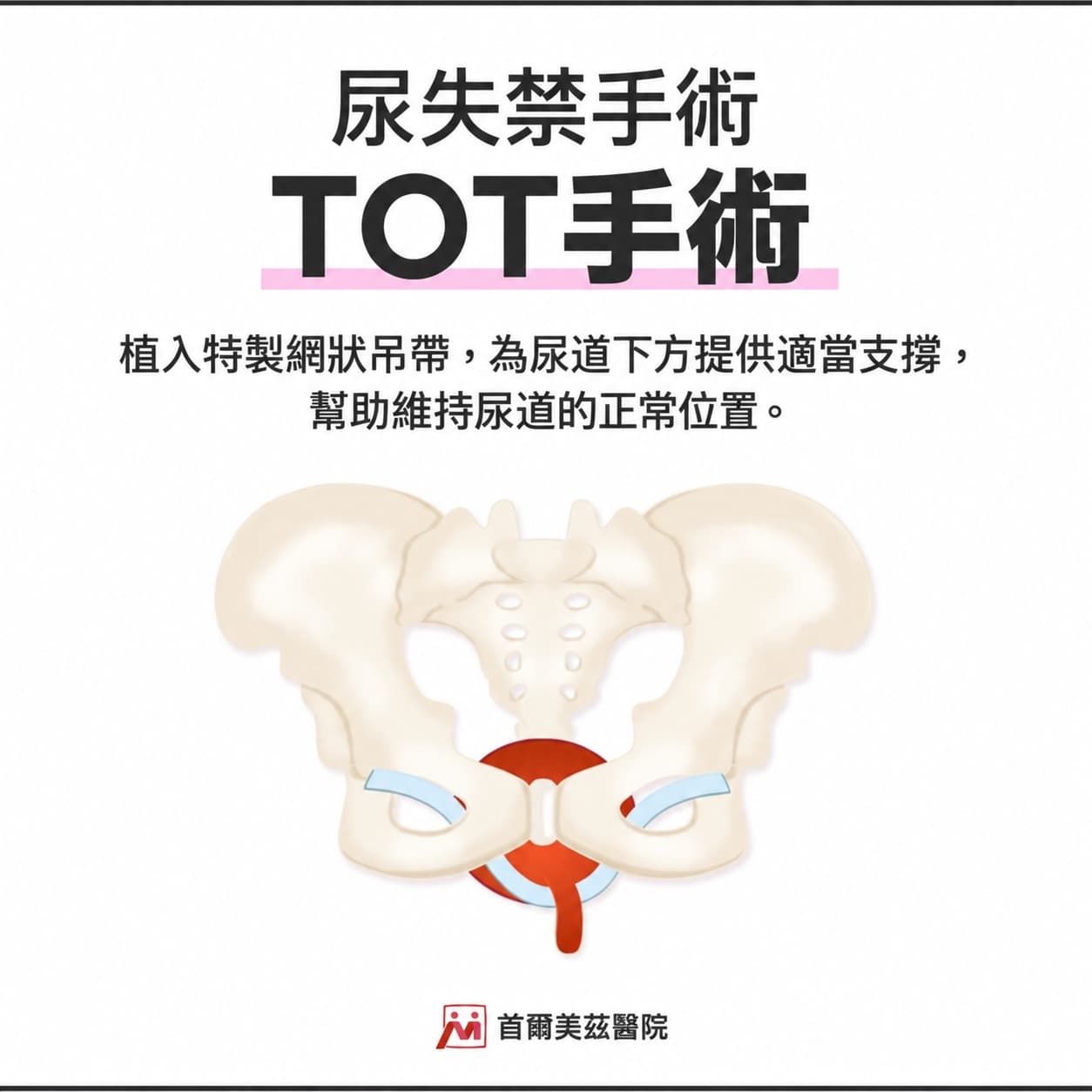 尿失禁手術(TOT)