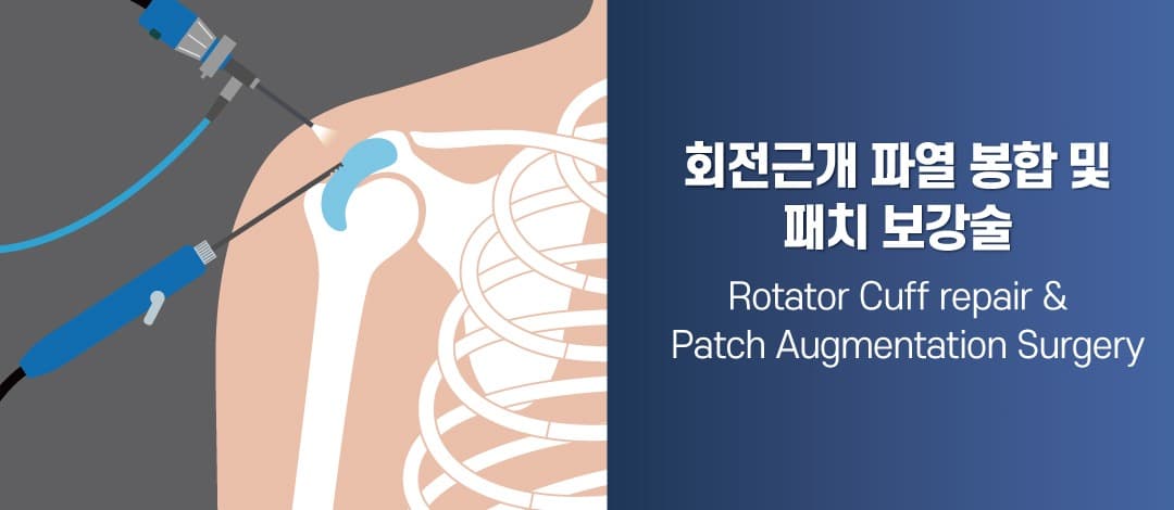 어깨 회전근개 파열 봉합 및 패치보강술