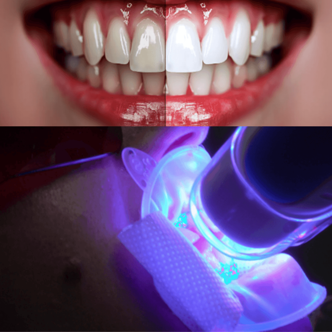 K – Whitening