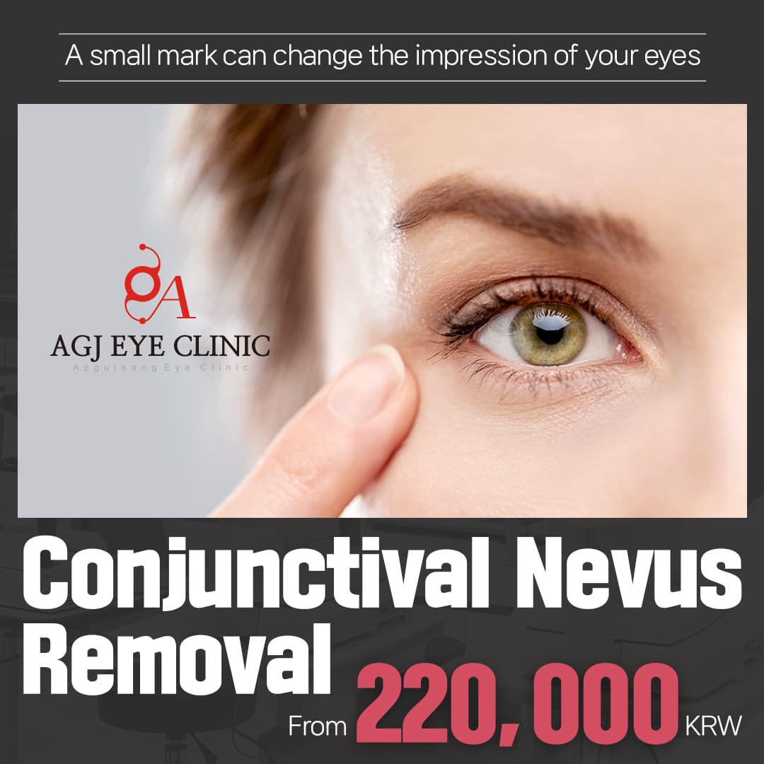 Conjunctival Nevus Removal