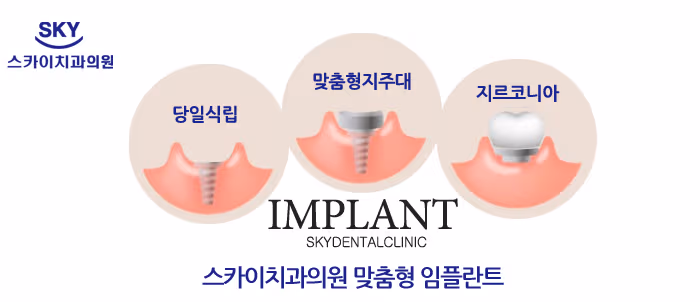 맞춤형 임플란트