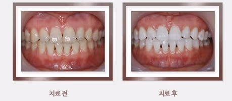 치아미백