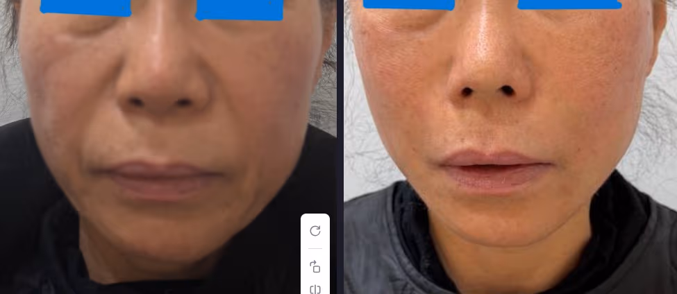 線雕拉提