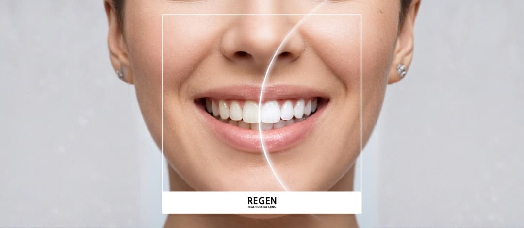 One-day Teeth whitening