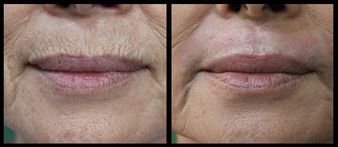 인중주름(고양이주름)