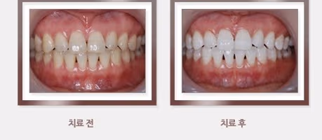 Teeth whitening