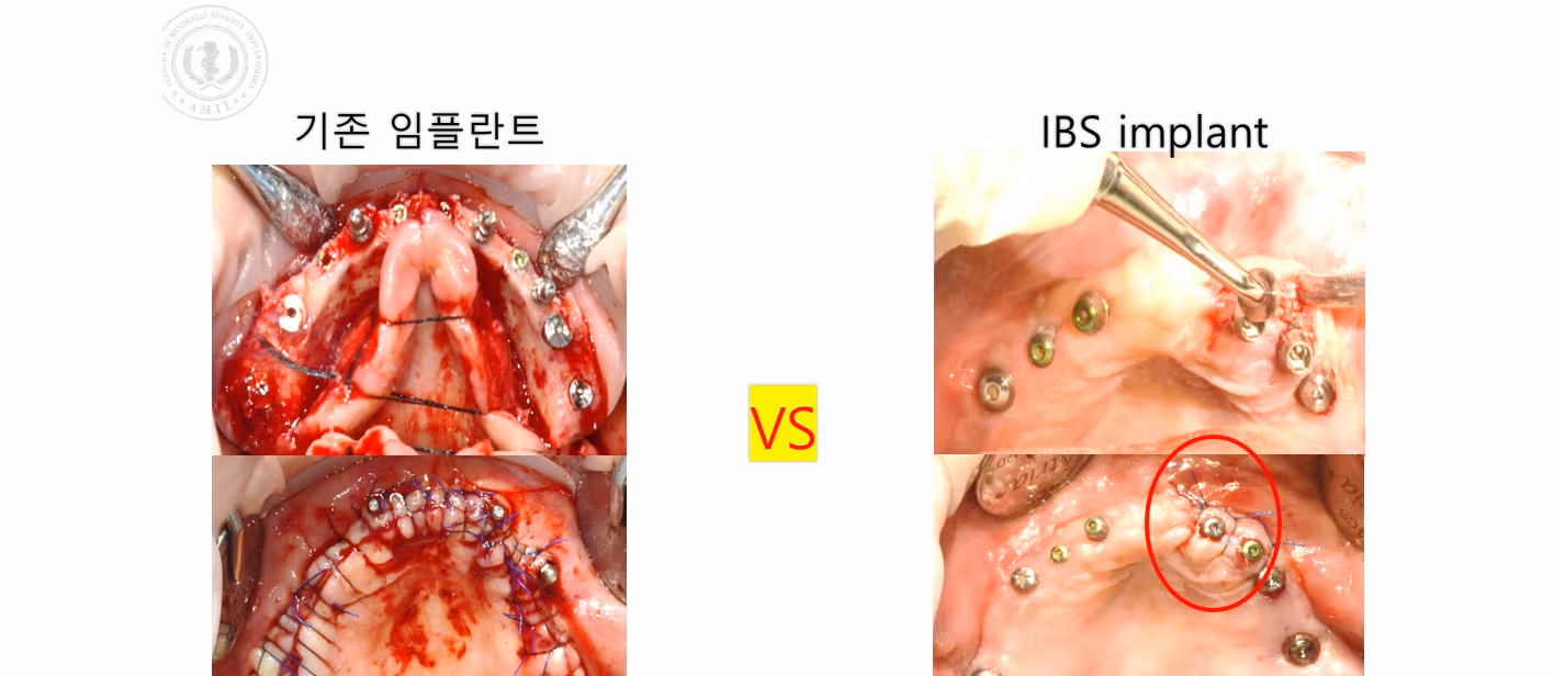 Non-incision, minimally invasive Dental implant