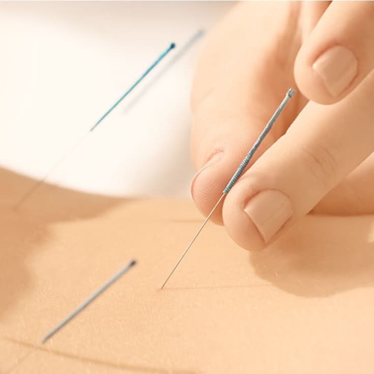 Immunotherapy acupuncture