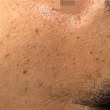 Geo-uchim (祛疣鍼) - A procedure for removing flat warts, seborrheic keratosis, and skin tags without the worry of scarring.