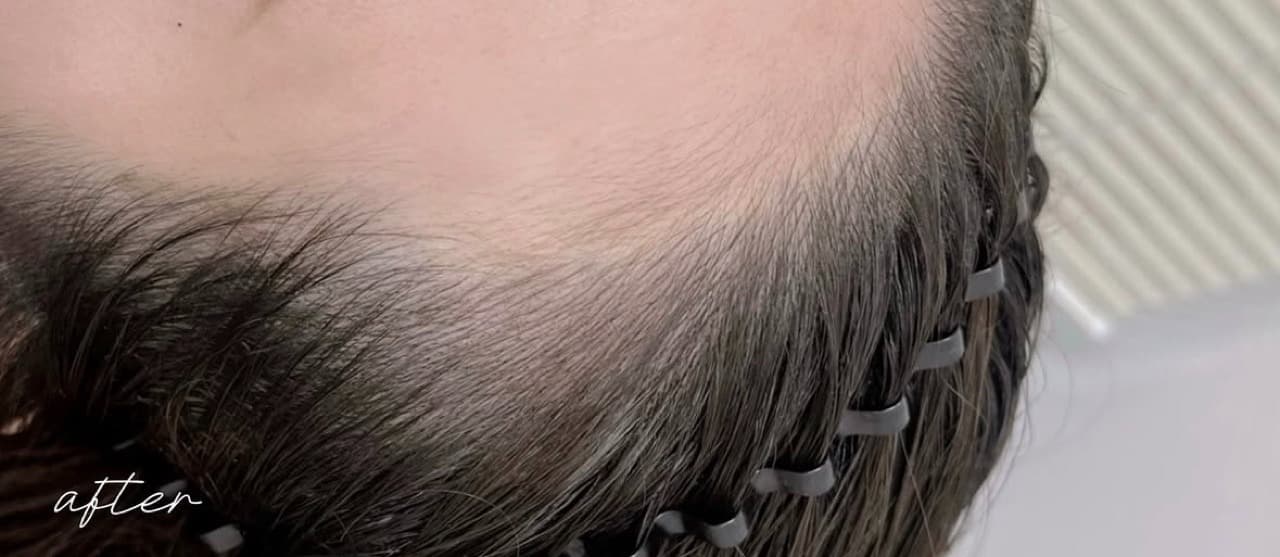 産毛のような自然な仕上がりのヘアラインアートメイク